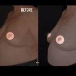 Inverted Nipple Surgery