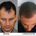 Hair Transplantation