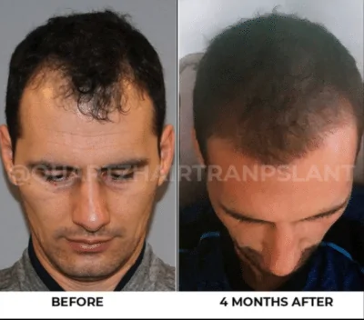 Hair Transplantation