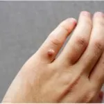 Wart Treatment