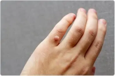 Wart Treatment