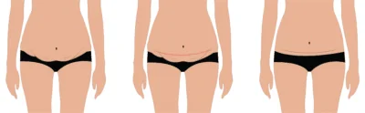 Tummy Tuck Scars