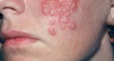 Herpes Treatment