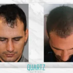 Haartransplantation