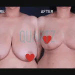 Breast Reduction Surgery