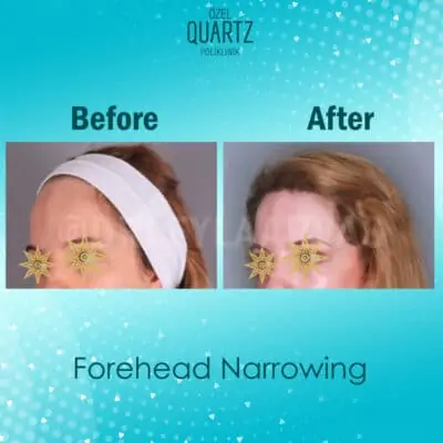 Forehead Reduction Surgery