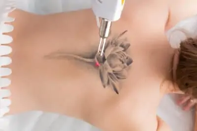 Laser Tattoo Removal