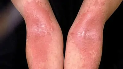 Eczema Treatment