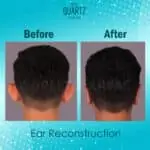 Prominent Ear Surgery