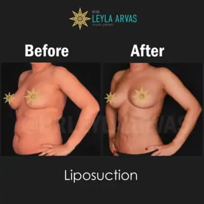 Liposuccion