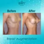 Breast Augmentation