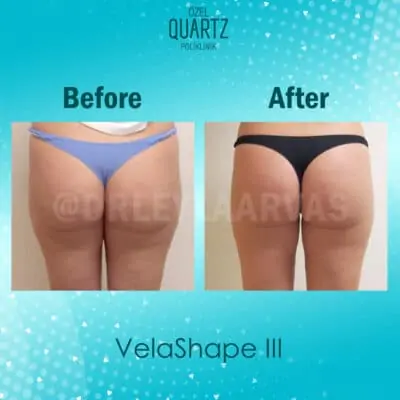 Mesotherapy Cellulite Treatment