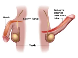 Sertleşme (Ereksiyon) Sorunu