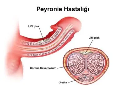 peyroni hastalığı 