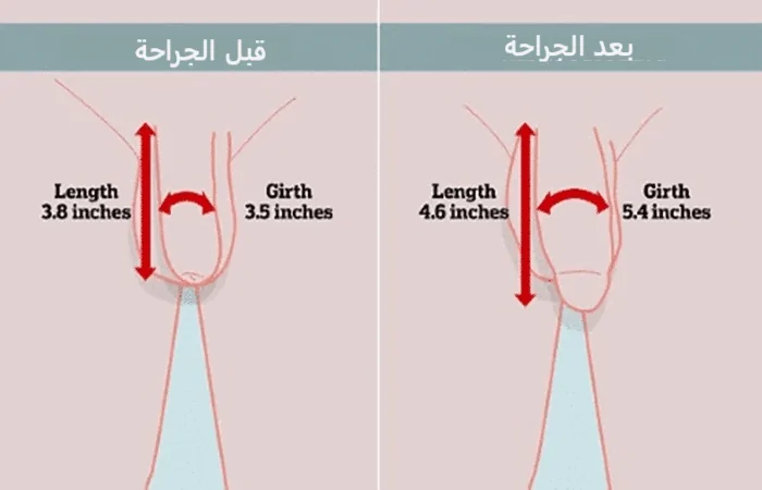 عملية زيادة سماكة القضيب - كوارتز كلينك - اسطنبول